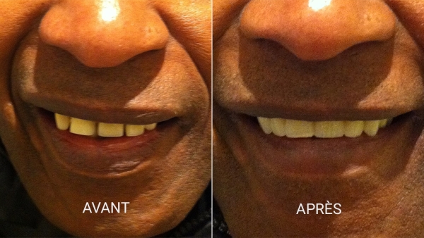Avant et après pour Alfred